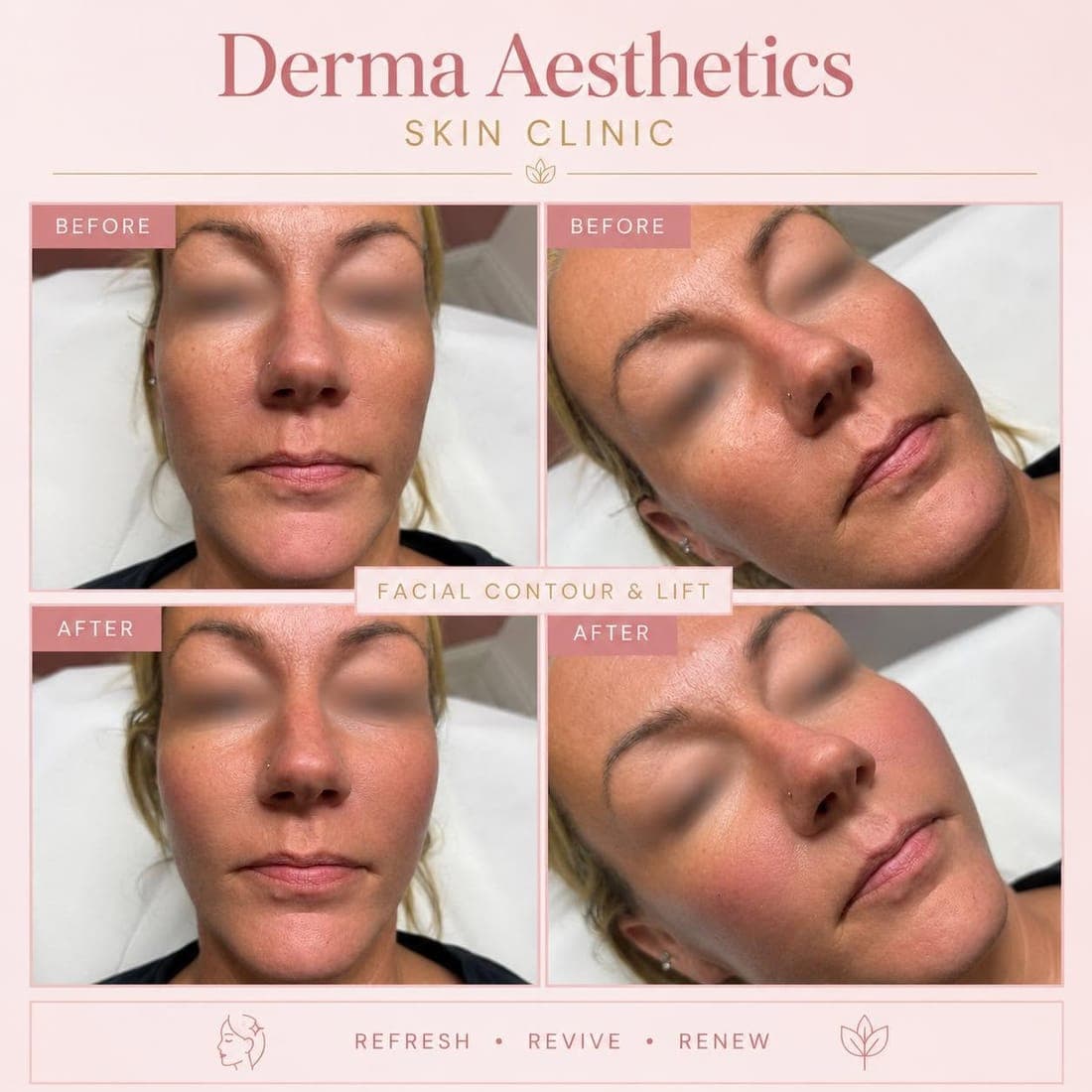 Derma Aesthetics card labelled Facial contour and lift: a client's face from the front and at an angle, before and after, eyes blurred