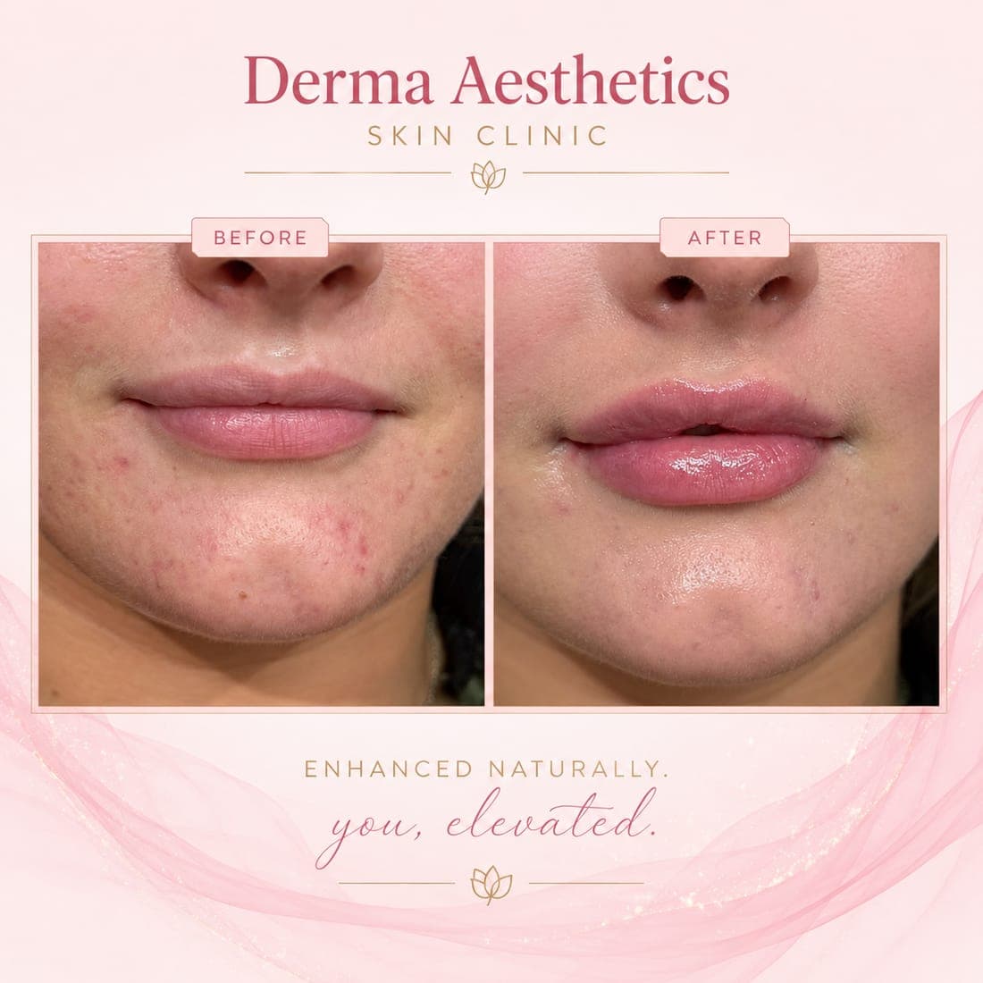 Derma Aesthetics card: a client's lips before and after, side by side, under the line Enhanced naturally, you, elevated