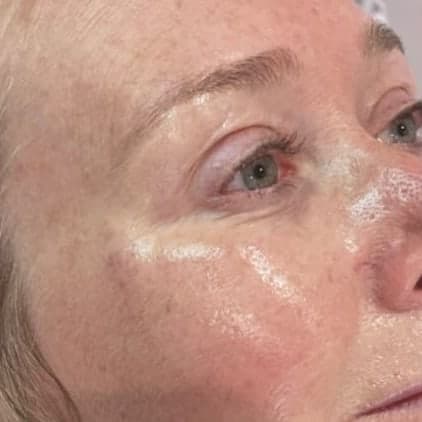 A client's eye and cheek from the side