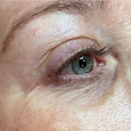 Close view of a client's eye and the skin around it