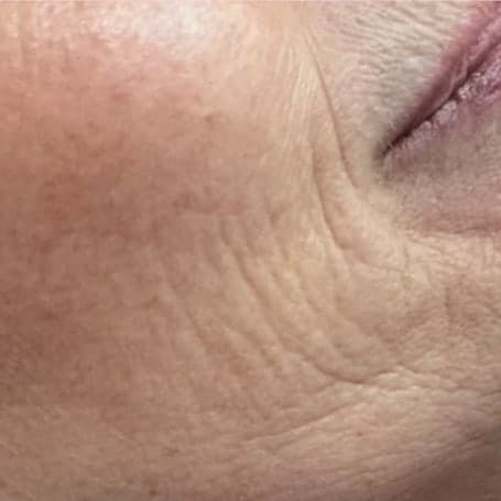 Close view of a client's cheek and lower face in profile, showing fine lines