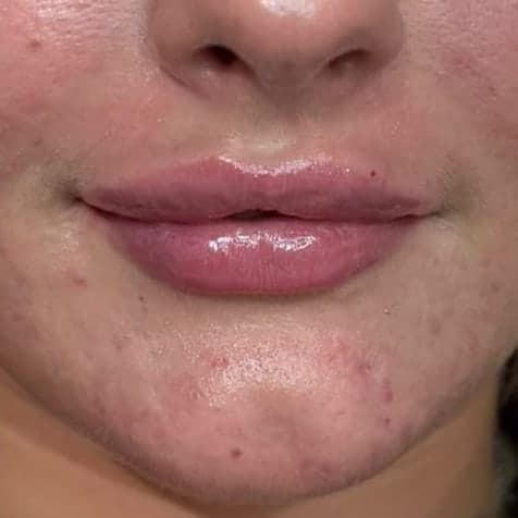 A client's lips from the front, soft and even