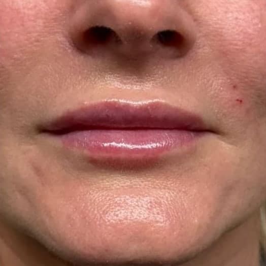 An older client's lips from the front, with a defined lip line