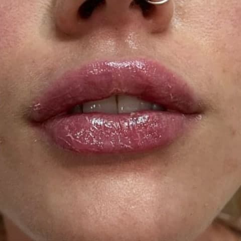 A client's full, glossy lips from the front