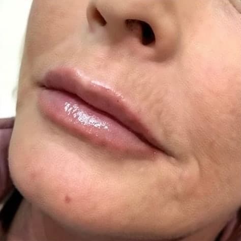 An older client's lips at a three-quarter angle