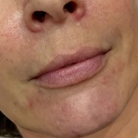 A client's lips from the front at a slight angle