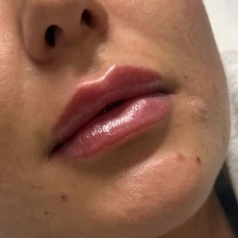 A client's lips from the side, smooth and defined