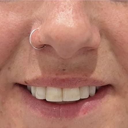 A smiling client's nose, mouth and cheeks, showing the skin